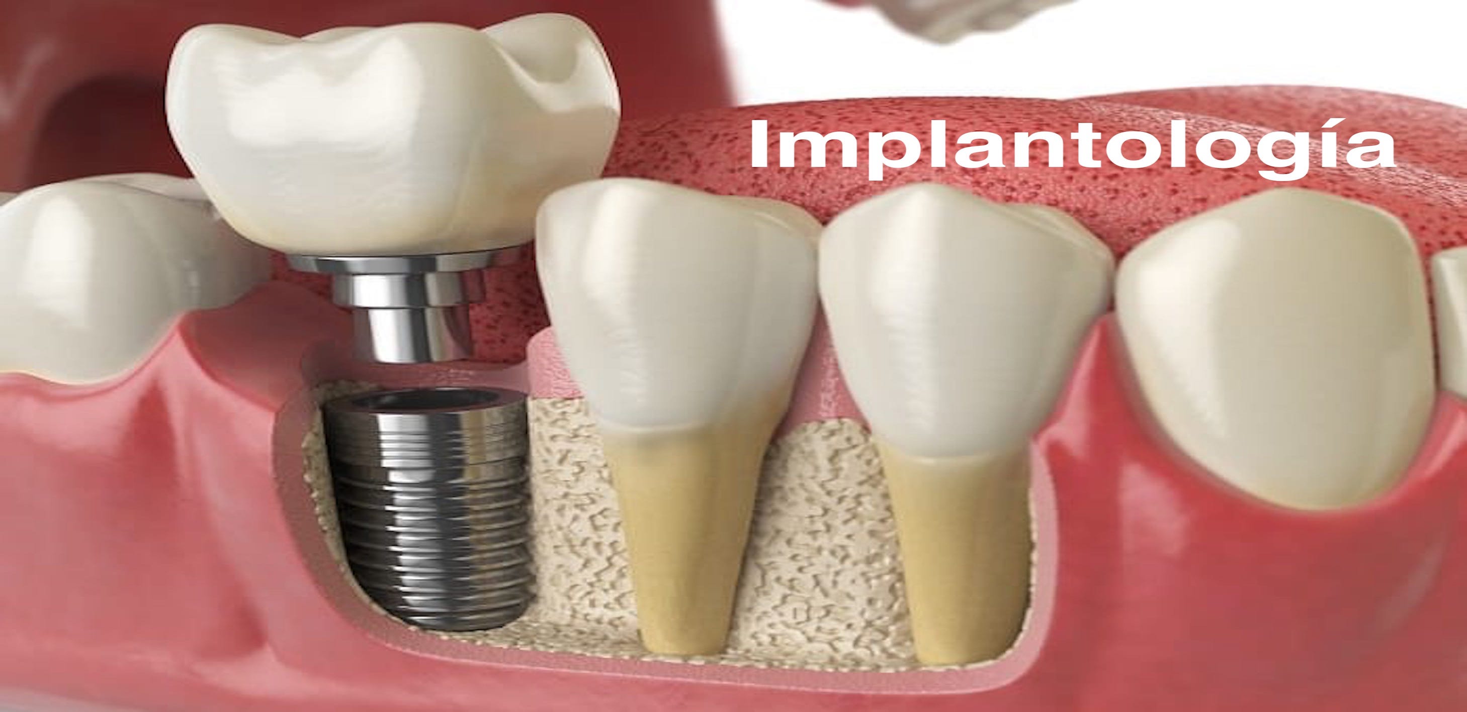 Implantología<br>¡Consulta por tu hora aquí!